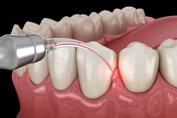 A Modern, Painless Approach to Treating Advanced Gum Disease: LANAP